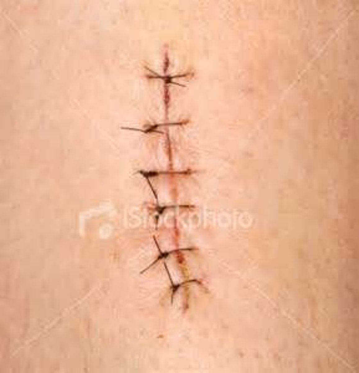 <p>stitches</p>