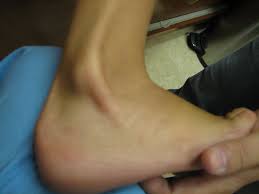 Dorsiflexion, eversion; subluxation of tendon