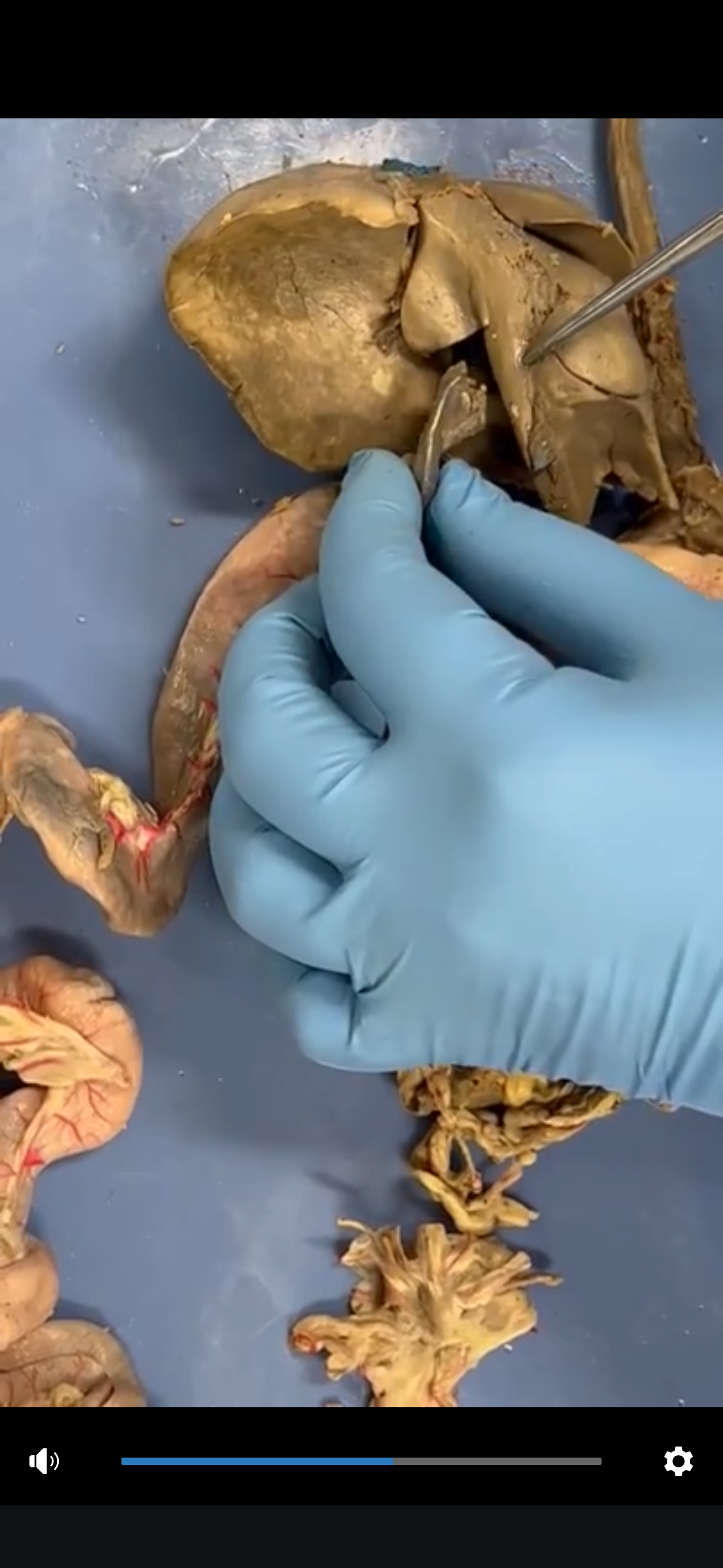 <p>Gallbladder</p>