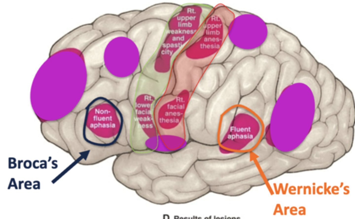 <p>spastic paralysis in the contralateral upper extremity (hyperreflexia, spasticity) and lower facial weakness </p>