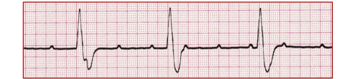 <p>3rd degree AV block (complete heart block)</p>