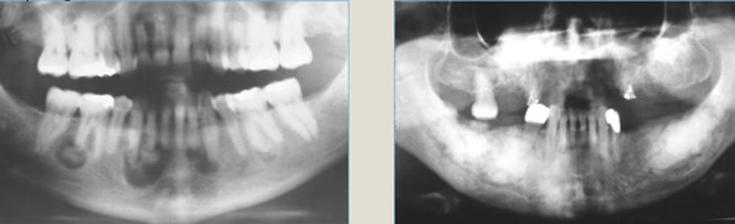 <p>LEFT: multiple mixed radiolucent/radipaque lesions involving ant/post mandible</p><p>RIGHT: multifocal radiopaque lesions of post jaw</p><p>What does opacity in the middle indicate?</p>