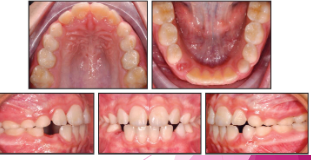 <p><strong><u>Primary:</u></strong></p><ul><li><p>shorter</p></li><li><p>narrow occlusal table</p></li><li><p>constricted in the cervical portion&nbsp;</p></li></ul><p><strong><u>Permanent:</u></strong></p><ul><li><p>bigger</p></li><li><p>broad occlusal table</p></li><li><p>cervical constriction is not well marked&nbsp;</p></li></ul><p></p>