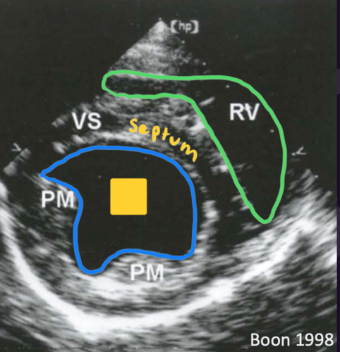 <p>Right parasternal short axis view</p>
