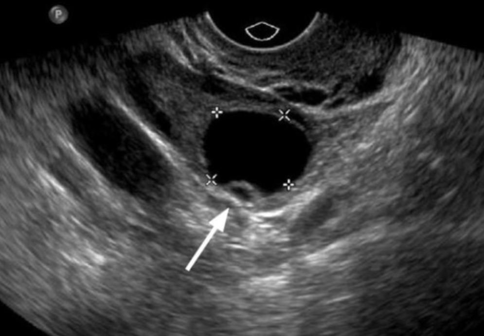 <p>What may occasionally be detected as an eccentrically located, cyst-like, 1 mm internal mural protrusion in the ovary?</p>