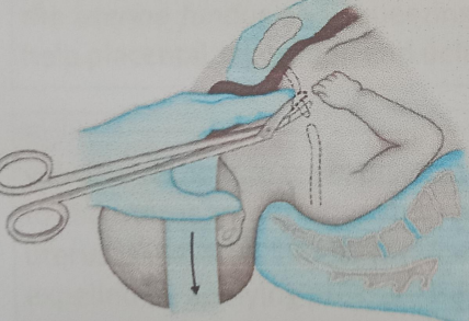 <p>procedure in which one or both clavicles are cut to reduce the biacromial diameters in cases of a shoulder dystocia not resolved by other maneuvers</p>