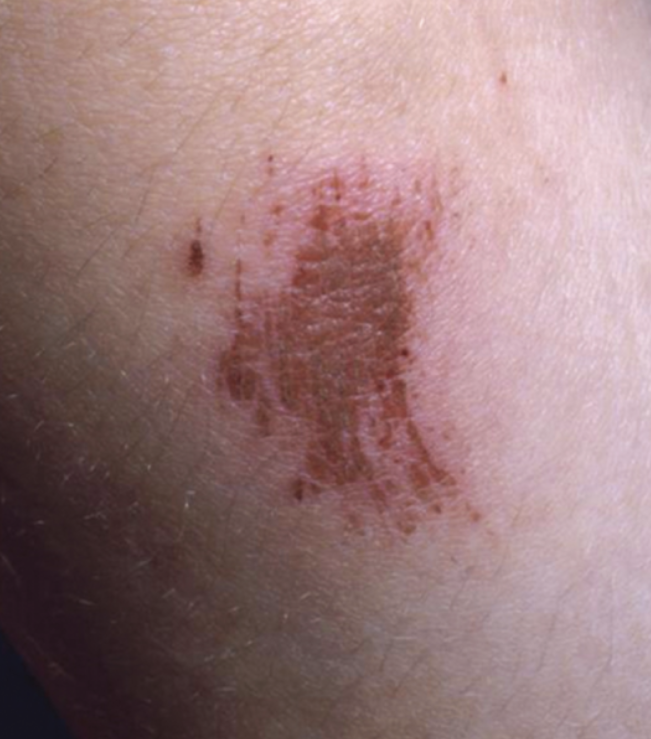 what type of skin wound?