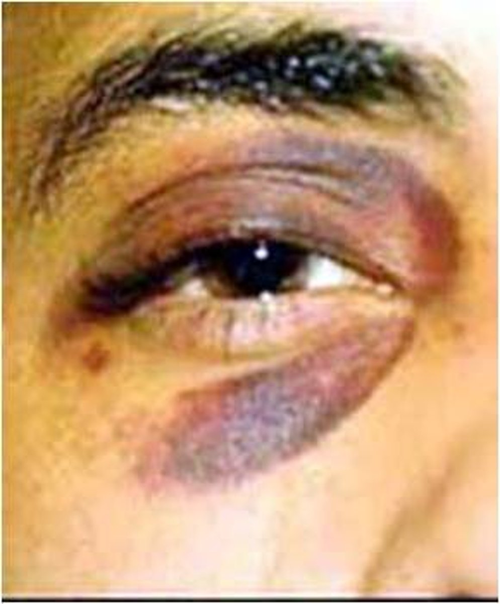 <p>A purplish patch resulting from extravasation (blood leaks from vessel) of blood into the skin (ex. black eye), &gt;3 mm in diameter.</p><p>-large region on the skin that looks purple because of blood that has leaked out of damaged vessels. the injured blood vessels have moved into the layers of the skin. The causes include injury from bumping yourself or medical conditions like leukemia or hemophilia.</p>