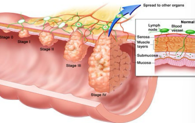 <p>What stage of colon cancer is this?</p><p>-Metastasis to distant organs </p>
