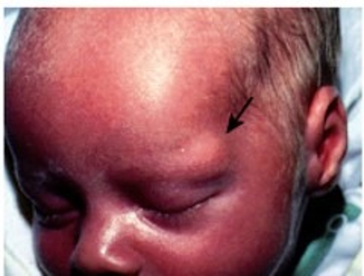 <p>-Closed sac that contains liquid or semisolid material</p><p>Causes:</p><p>-Cystic acne</p><p>-Sebaceous cyst </p><p>Note: can get infected (antibiotics)</p>