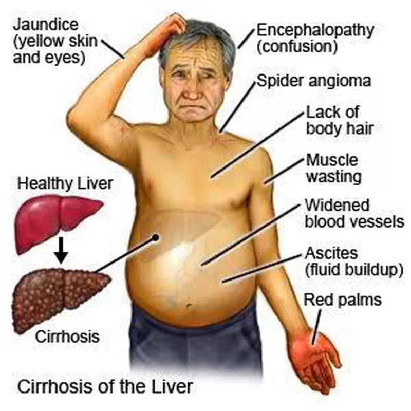 <p>What are the <strong>complications </strong>of<strong> cirrhosis?</strong></p>