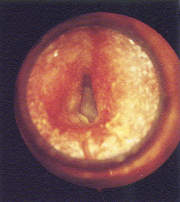 <p><u>disordered otoscopy: canal</u></p><p>otitis externa/external otitis</p>