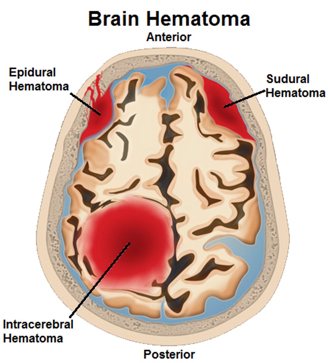 <p>- local hemorrhage: 'bruising' (ecchymosis (bleeding under the skin) => reabsorbed)</p><p>- large hemorrhage = hematoma</p>