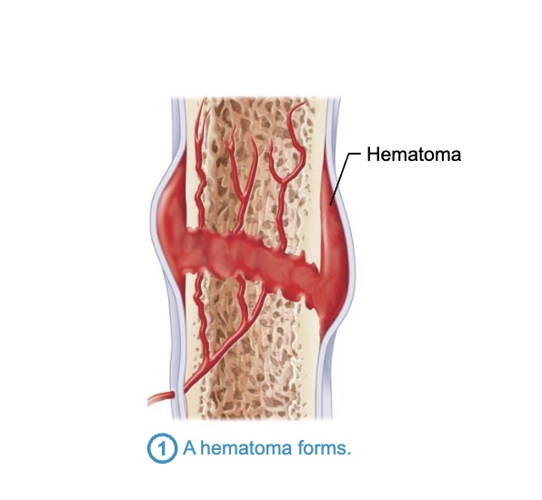 <p>– Torn blood vessels hemorrhage, forming mass of clotted blood called a</p><p>hematoma</p><p>– Site is swollen, painful, and inflamed</p><p></p>