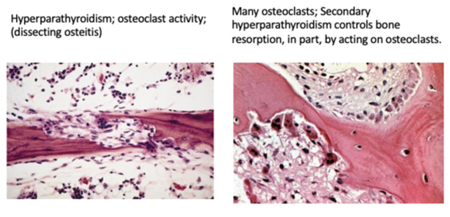 <p>hyperparathyroidism <br><br>(I think this is just a word for lots of osteoclast activity?)</p>