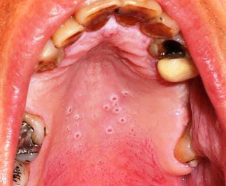 <p>13d. What is the most appropriate management for this patient?</p>