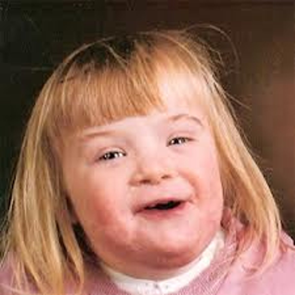 <p>a human genetic disease resulting from having an extra chromosome 21 (characterized by having a delay in mental development).</p>