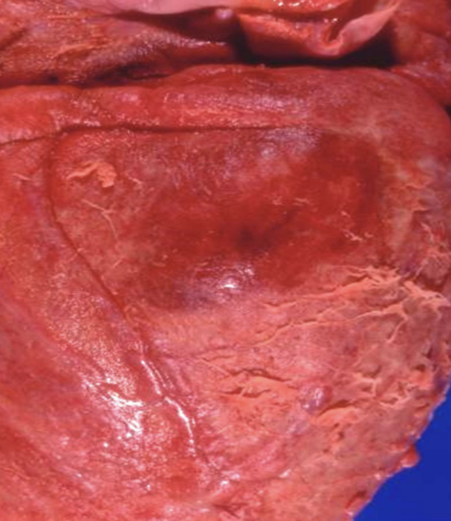 <p>Inflammation with fibrin-rich exudate that can form fibrous networks on surfaces made of fibrinogen (large plasma protein)</p><p>Seen in strep throat, pneumonia, fibrinous pericarditis</p>