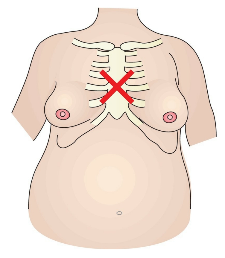 <p>The fist is placed against the middle of the woman’s sternum, with backward thrusts until the foreign body is expelled. The pressure from the backward thrusts causes compression of the ribs, further adding to the chest and lung pressure, thereby forcing the foreign body to move upward.</p>