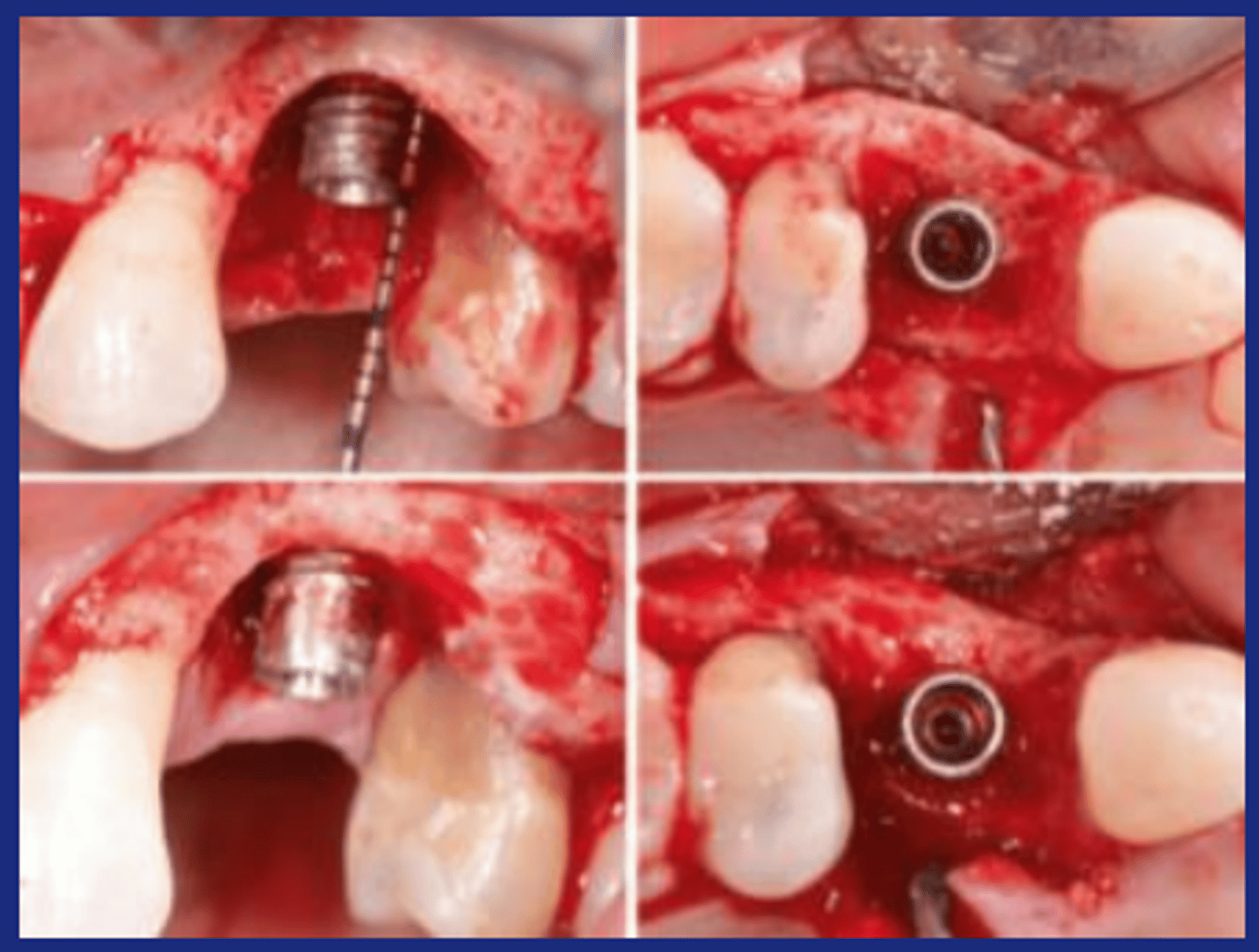 <p>- Adjunct to surgery in peri-implantitis treatment</p><p>- Removal of the windings &amp; rough surface of the contaminated implant &amp; a subsequent polishing</p><p>- Aim to obtain smooth implant surface for better pt biofilm control</p>