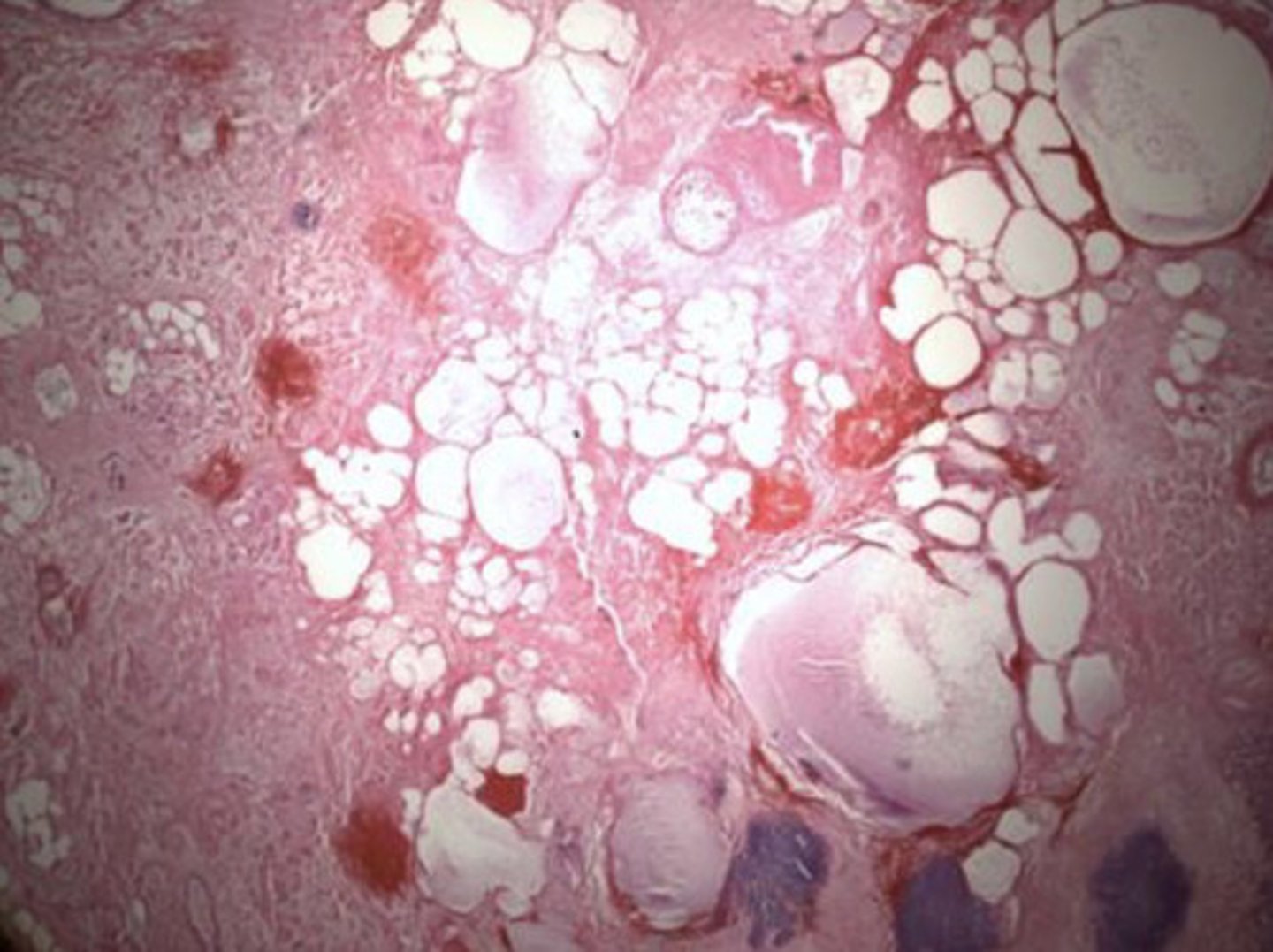 <p>What type of necrosis is being seen here?</p>