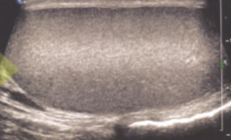 <ul><li><p><span style="background-color: transparent;">Horizontal brightness at the level of the focus</span></p></li><li><p><span style="background-color: transparent;">Occurs because of the increased intensity in the focal zone</span></p><ul><li><p><span style="background-color: transparent;">Results in increased amplitude of echoes</span></p></li><li><p><span style="background-color: transparent;">There’s increased intensity of the beam at the focal zone because the intensity equals power divided by area and since the area goes down at the focus, the intensity is increased.</span></p></li></ul></li><li><p><span style="background-color: transparent;">Adjust TGCs to fix</span></p></li></ul><p></p>