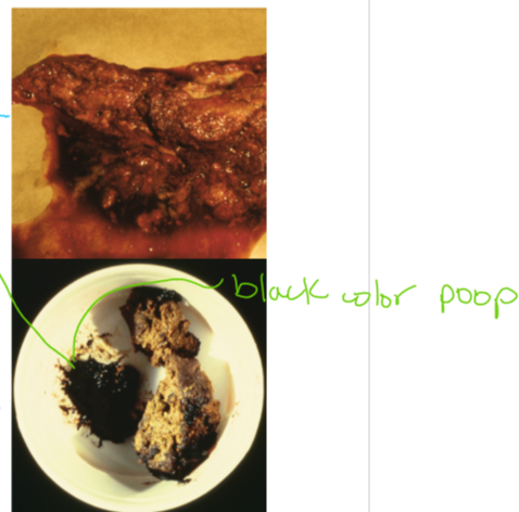 <p><strong>Gastrointestinal bleeding: </strong></p><ul><li><p>iron deficiency/chronic blood loss/microcytic hypochromic anemia</p></li><li><p>hematemesis </p></li><li><p>melena </p></li><li><p>pale mucous membranes and anemia </p></li></ul><p><strong>Delayed gastric emptying: </strong></p><ul><li><p>Rexongiziable food in vomitus >10 hours after eating </p></li><li><p><strong>projectile vomiting </strong></p><ul><li><p>common with pyloric obstruction </p></li></ul></li><li><p>bloating </p></li><li><p>belching </p></li><li><p>metabolic alkalosis </p><ul><li><p>net loss of acid from body </p></li></ul></li></ul><p></p>