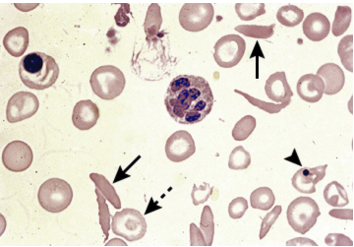 <p>Diagnostics for Sickle cell anemia</p>