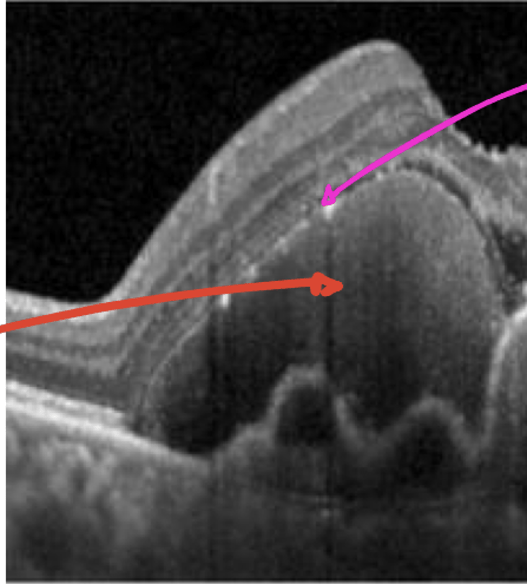 <p>What color would this heme be on fundus photo?</p>