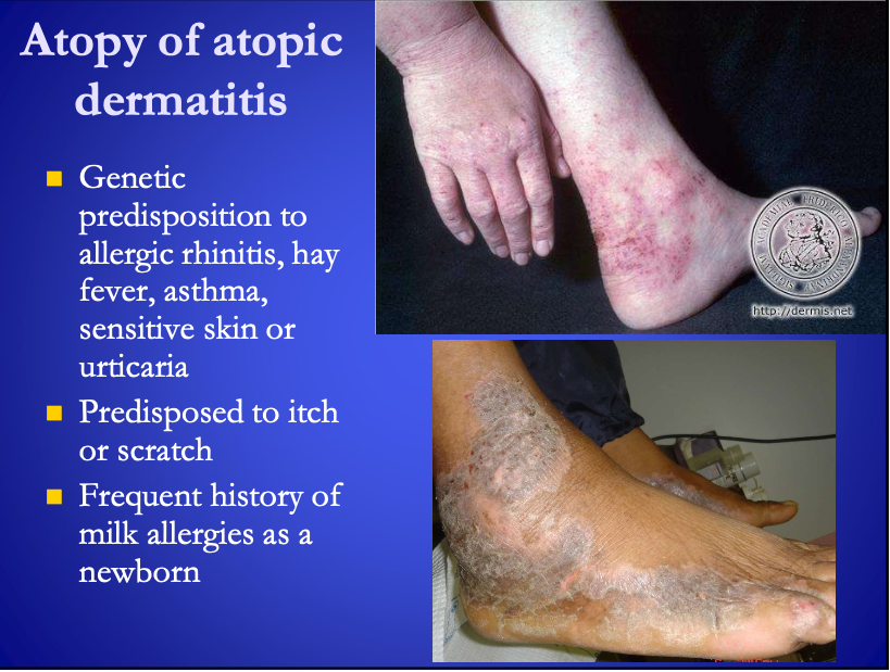 <p><span><strong>[...]</strong></span></p><ul><li><p>Genetic predisposition to allergic rhinitis, hay fever, asthma, sensitive skin or urticaria</p></li><li><p>Predisposed to itch or scratch&nbsp;</p></li><li><p>Frequent history of <span>milk allergies</span> as a newborn&nbsp;</p></li></ul><p></p>
