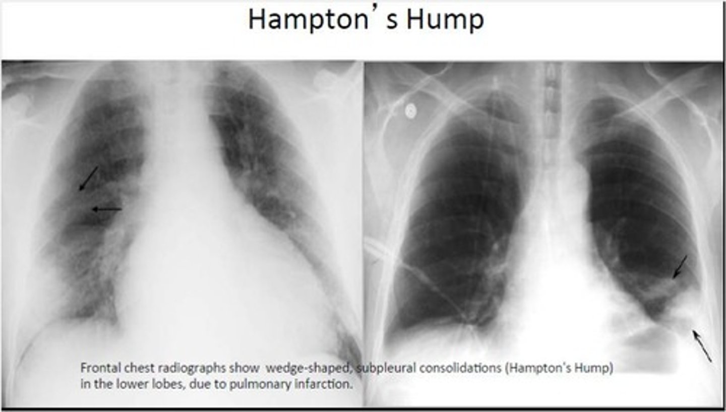 <p>Hampton's hump</p>