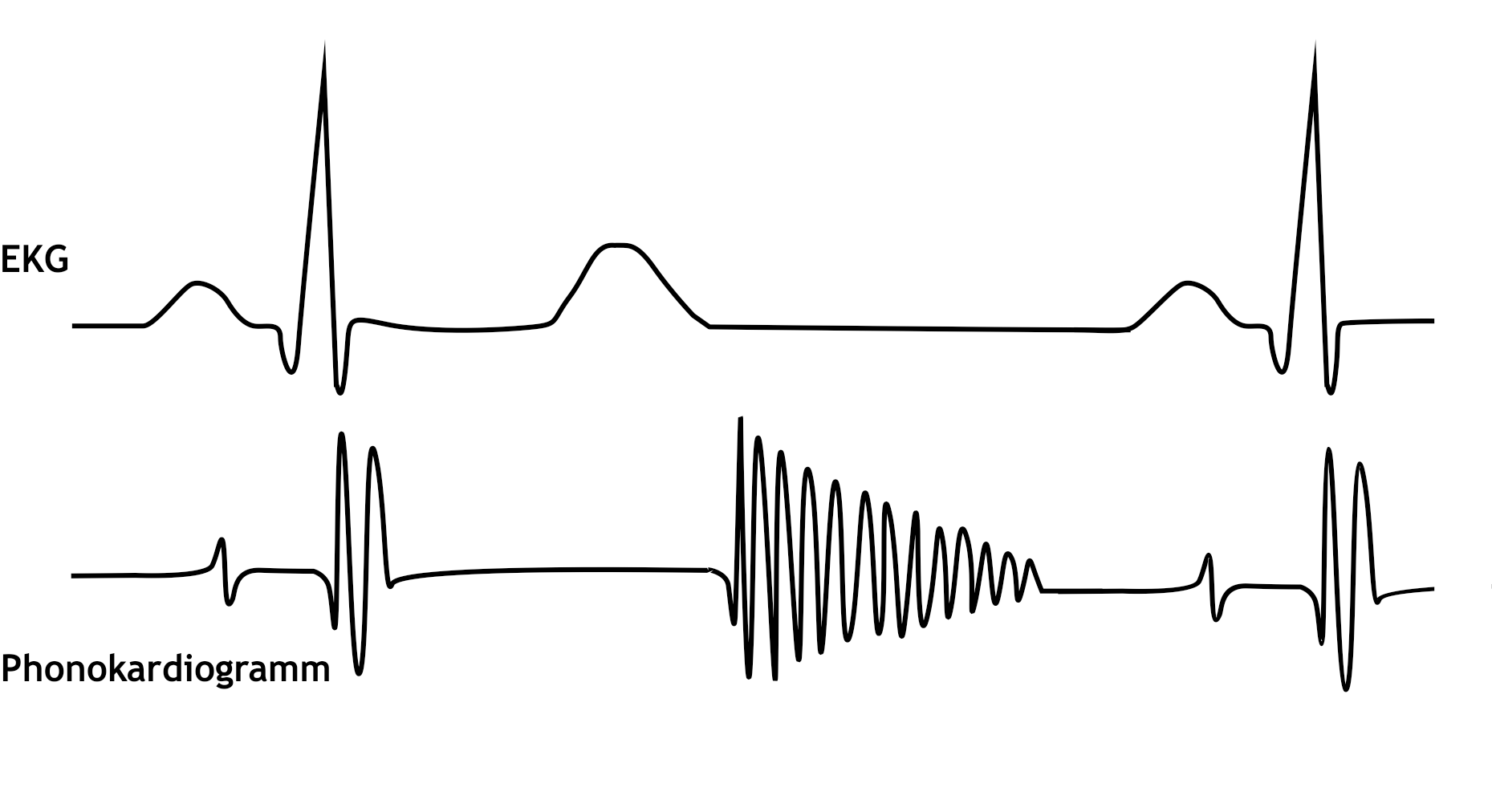 <p>9. A 60-year-old man undergoes a cardiological examination. An electrocardiogram and a phonocardiogram are recorded simultaneously. </p><p>Which conclusion from these two recordings is most likely correct?</p><p>A. There is no indication of heart disease.</p><p>B. There is suspicion of aortic valve insufficiency.</p><p>C. There is suspicion of mitral valve insufficiency.</p><p>D. There is suspicion of pulmonary valve stenosis.</p><p>E. There is suspicion of a ventricular septal defect.</p>