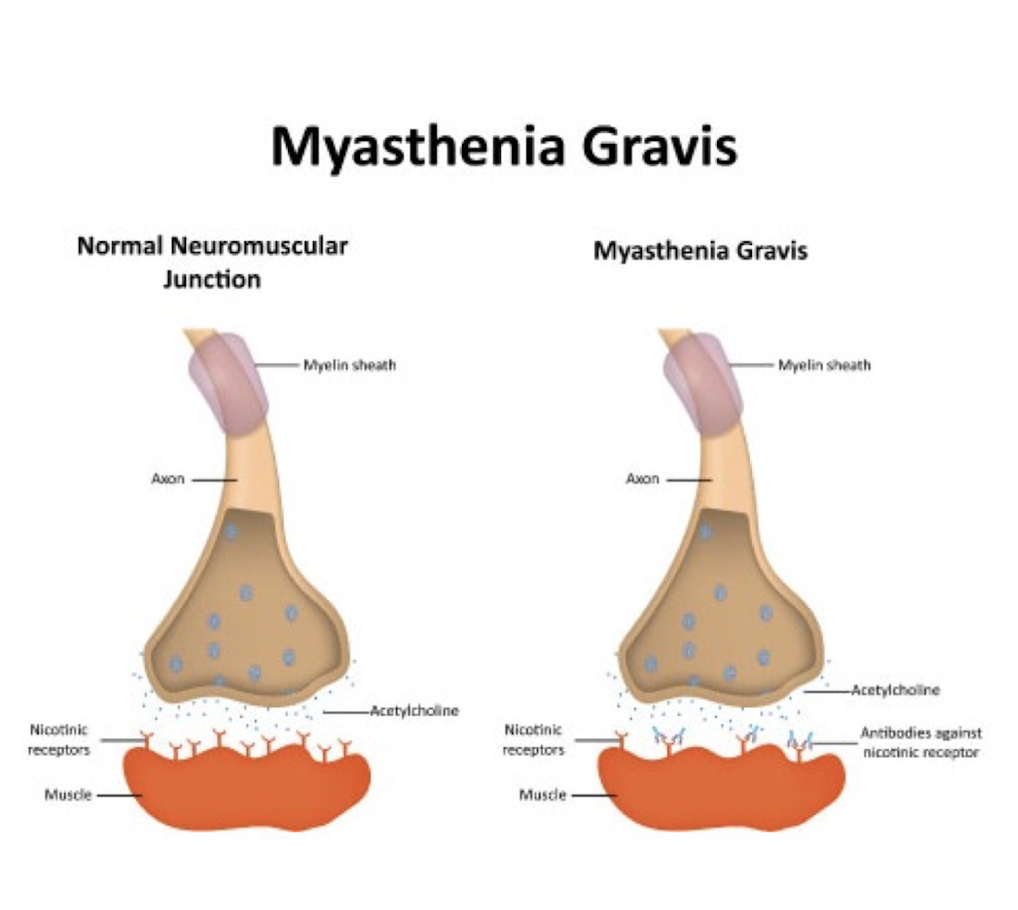 <p>Myesthenia Gravis:</p><ul><li><p>Describe: (3)</p></li></ul><ul><li><p>Cause:</p></li><li><p>UMN or LMN?</p></li></ul><p></p><p></p>