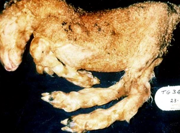 <p>Arthrogryposis, hydrancephaly</p>