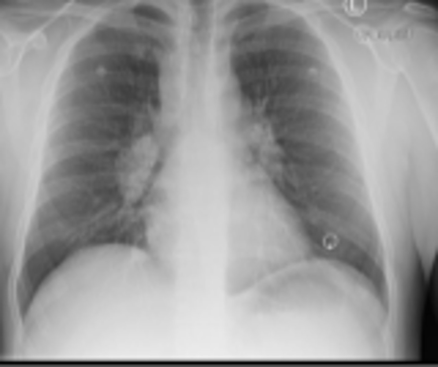 <p>- I: hilar lymphadenopathy</p><p>- IV: overt pulmonary fibrosis</p>