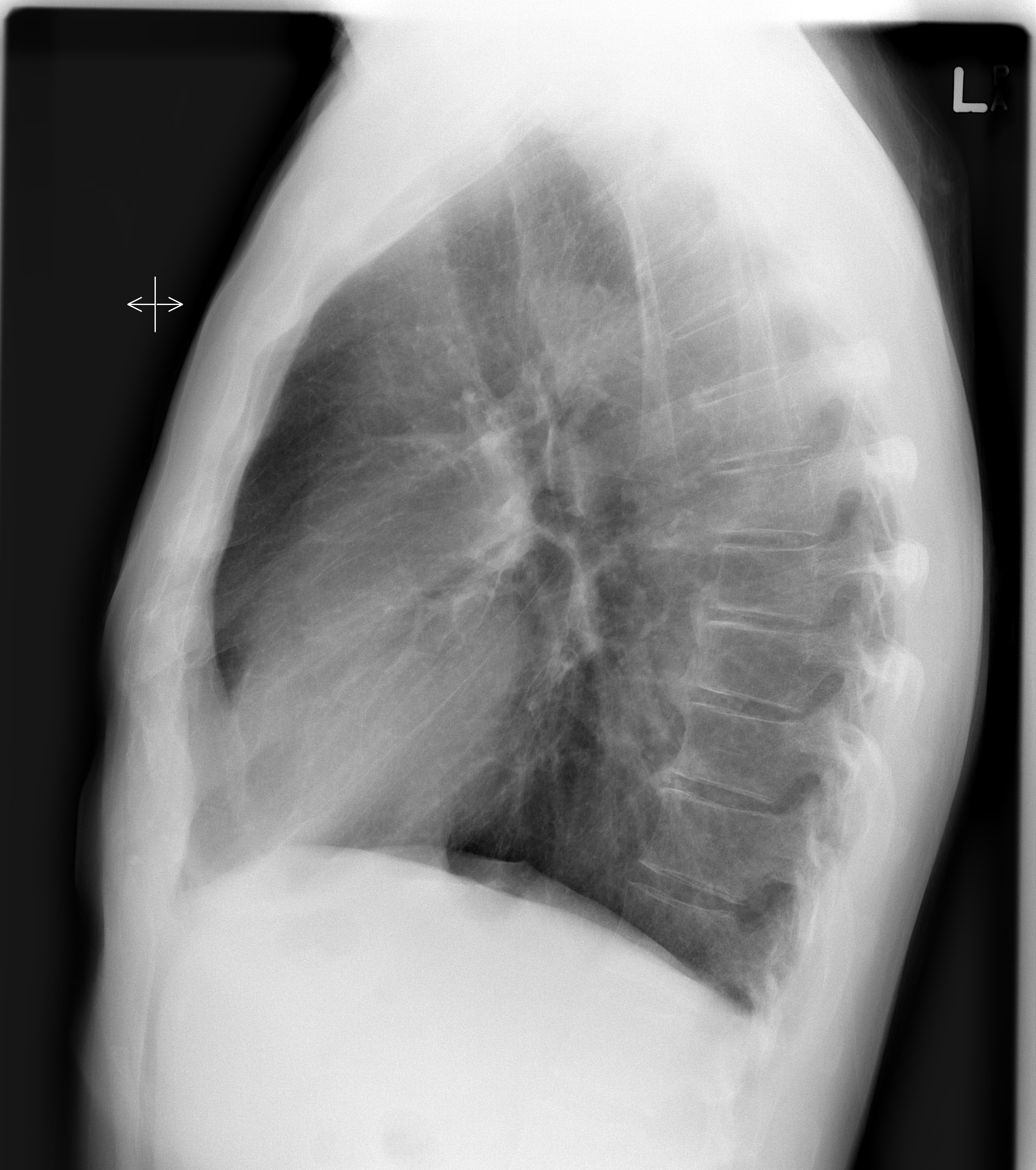 <p>The midcoronal plane should be parallel to the IR; look for symmetric apices and hemidiaphragms.</p>