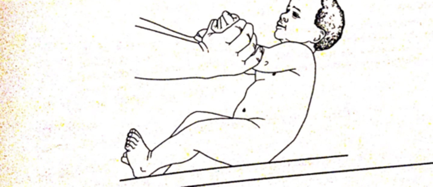 <p>-no head lag with pull to sit</p><p>-Sits with support</p><p>-Laughs</p><p>-Rolls prone to side, supine to side</p><p>-Optical and labyrinthine reflex present</p><p>-ulnar palmar grasp</p>