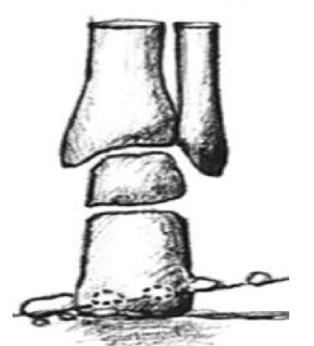 <p>A. Uncompensated forefoot valgus</p>