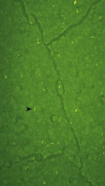 <p>8.8 Side B (PBD9: 371; BP9: 493)<br></p>
<p><br></p>
<p>Questions<br></p>
<p>A 53-year-old man has miliary nodules on imaging and acid-fast bacilli on liver biopsy.<br></p>
<p><br></p>
<p>1. What is shown here?<br></p>
<p>2. What skin testing is useful?<br></p>
<p>3. What histologic appearance is expected?<br></p>