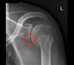 <p>What lesion is shown in this xray?</p>
