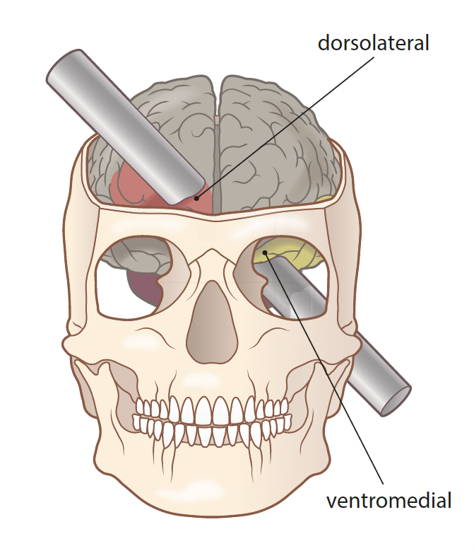 <p>there was likely to have been damage in both the right and the left hemispheres of the frontal lobe</p><p>the damage was likely to have only affected the frontal lobe and no other parts of the brain</p><p>the iron bar would have passed through the left eye socket and upwards through the head</p><p>there was likely to have been more damage to the underlying white matter in the left hemisphere than in the right frontal lobe</p><p>the damage in both hemispheres seemed to be worse in the middle of the underside (ventromedial region)</p>