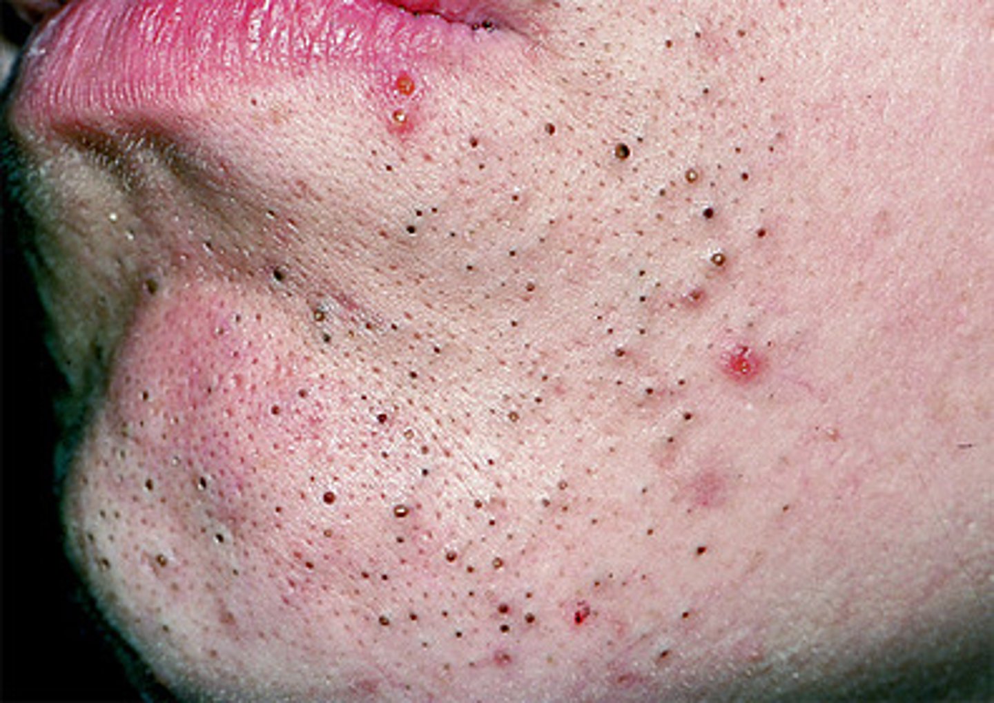 <p>Open comedones (blackheads) </p>
