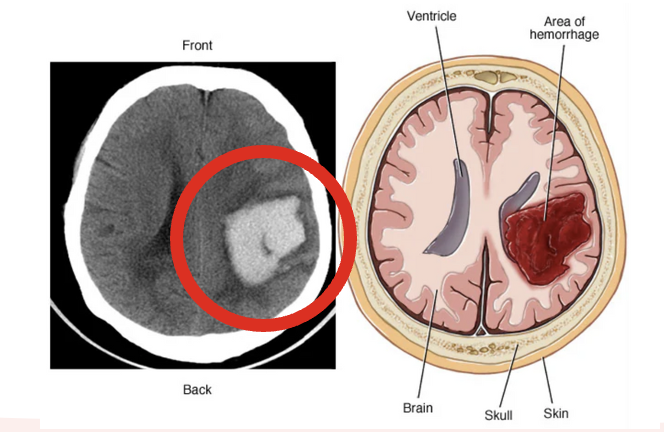 <p>Bleeding into parenchyma of brain; commonly from force to head over a small area (missile injuries, bullets, etc.); can also be a result of non-traumatic origin.</p><ul><li><p><strong>Clinical Manifestations</strong>:</p><ul><li><p>Subtle onset of symptoms</p><ul><li><p>Starts with new neurologic deficits then headache</p></li><li><p>Nausea/Vomiting (b/c of brain stem compression)</p></li></ul></li></ul></li><li><p><strong>Management</strong>:</p><ul><li><p>Supportive care (pain, N/V, noise reduction, cluster care, low stimulation)</p></li><li><p>Control of ICP</p></li><li><p>Administration of fluids, electrolytes and anti-hypertensives</p></li><li><p>Surgery (craniotomy or craniectomy)—to remove clot and control hemorrhage but not always possible</p></li></ul></li></ul><p></p>