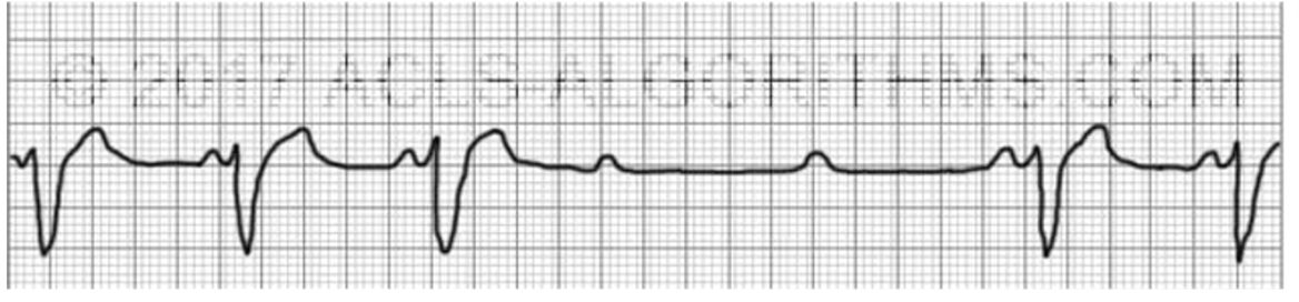 <p>what is 2nd DEGREE TYPE 2 HEART BLOCK nursing action</p>