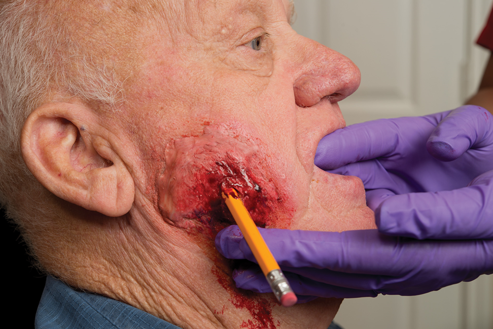 <p><span style="background-color: yellow; color: rgb(0, 0, 0);"><mark data-color="#ffffff" style="background-color: rgb(255, 255, 255); color: inherit;"><span>The process of removing an impaled object from the cheek.</span></mark></span></p>