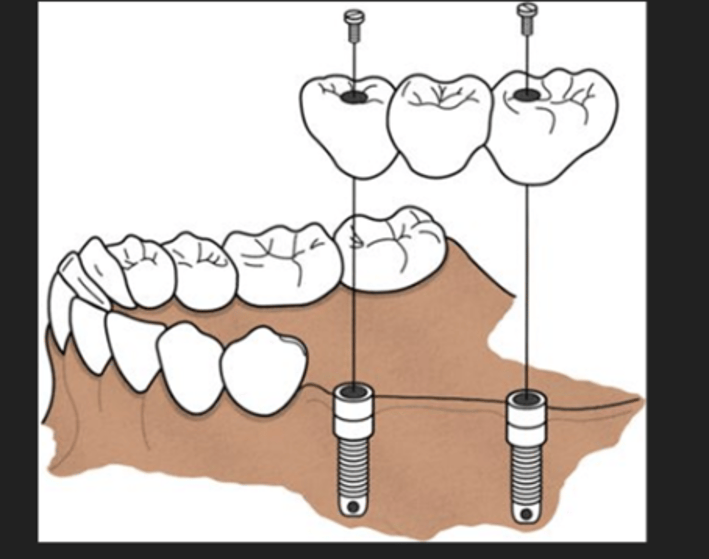 <p>implant bridge</p><p>2 implants acting as abutment and middle is the missing tooth</p>