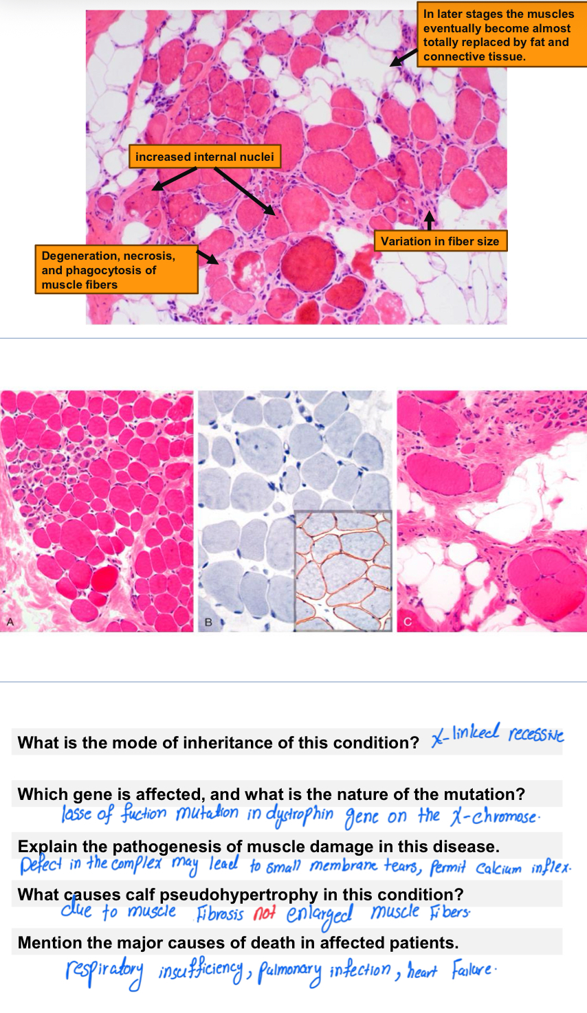 <p><strong><u>Duchenne Muscular Dystrophy</u> </strong></p>
