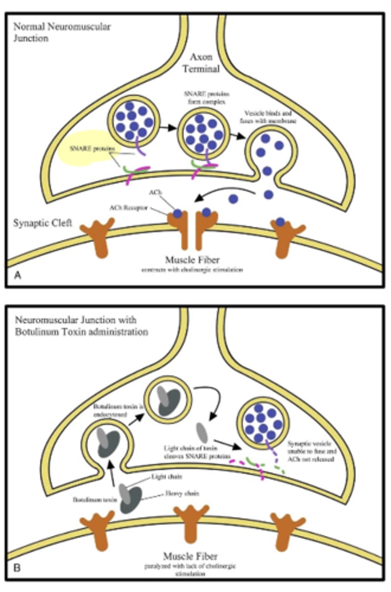 <p>Ach causes muscles to contract</p><p>Toxin: </p><p>- Block Snare proteins from guiding Ach to the nerve membrane.</p><p>- Muscle is relaxed = Paralysis (do not contract) </p><p>- 8 known toxins A, B, C, D, E, F, G, and F/A hybrid (formerly H)</p><p>- A: Most common in the U.S., especially west of the Mississippi. Responsible for ~50% of foodborne outbreaks.</p><p>- Also widely used therapeutically (e.g., Botox).</p><p>- 2012: Toxin can get into the central nervous system</p>