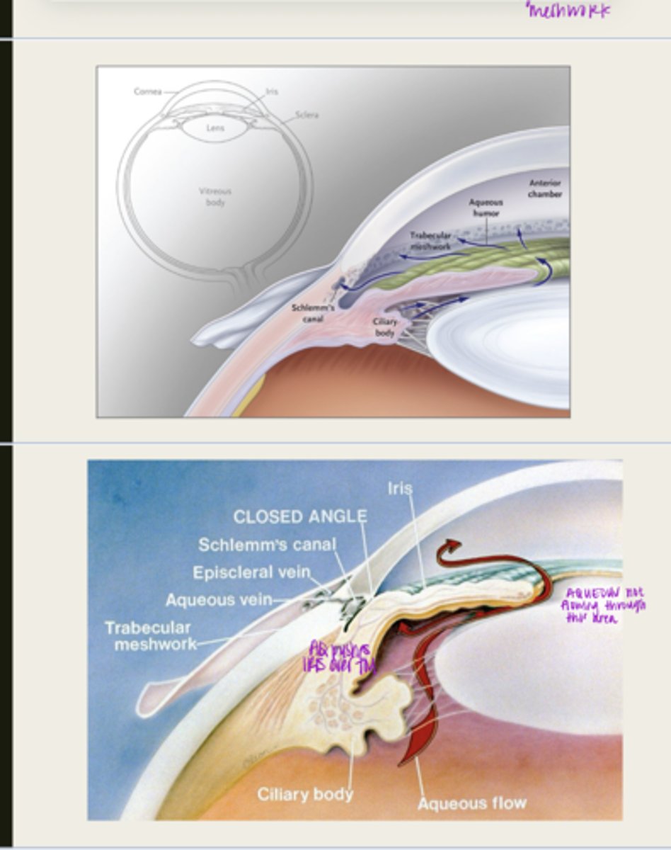 <p>What happens to the iris with pupillary block?</p>