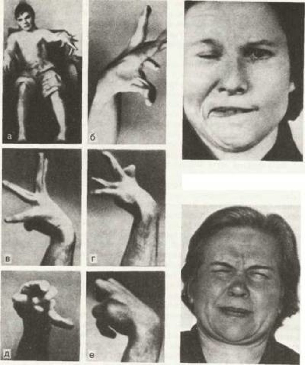 <p>a side effect of long-term use of traditional psychoactive medications in which people have uncontrollable movements, tremors, or spasms (related to the regulation of dopamine</p><p>in the nervous system)</p>